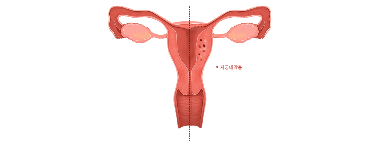 자궁선근증